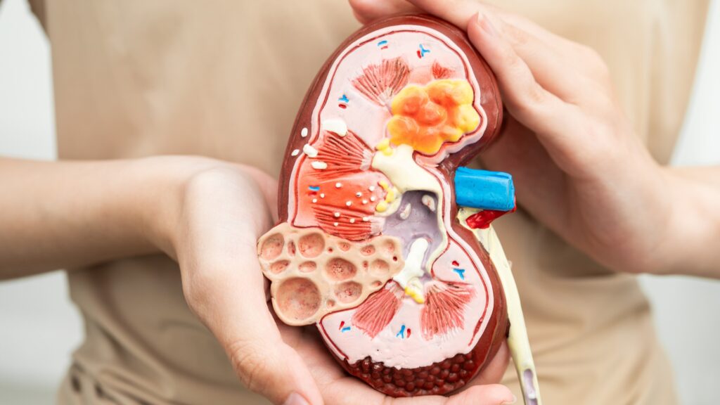 Cuando un cálculo renal no puede esperar y necesita cirugía