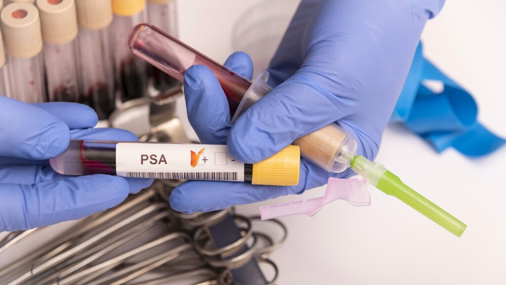 PSA elevado: ¿Significa que tengo cáncer? Mitos y verdades