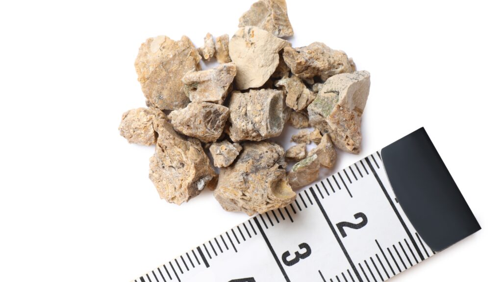 Piedras en el riñón: 7 señales que no debes ignorar