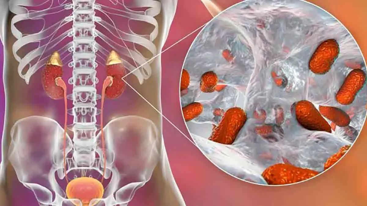 Pielonefritis Aguda: Síntomas, Diagnóstico Y Tratamiento