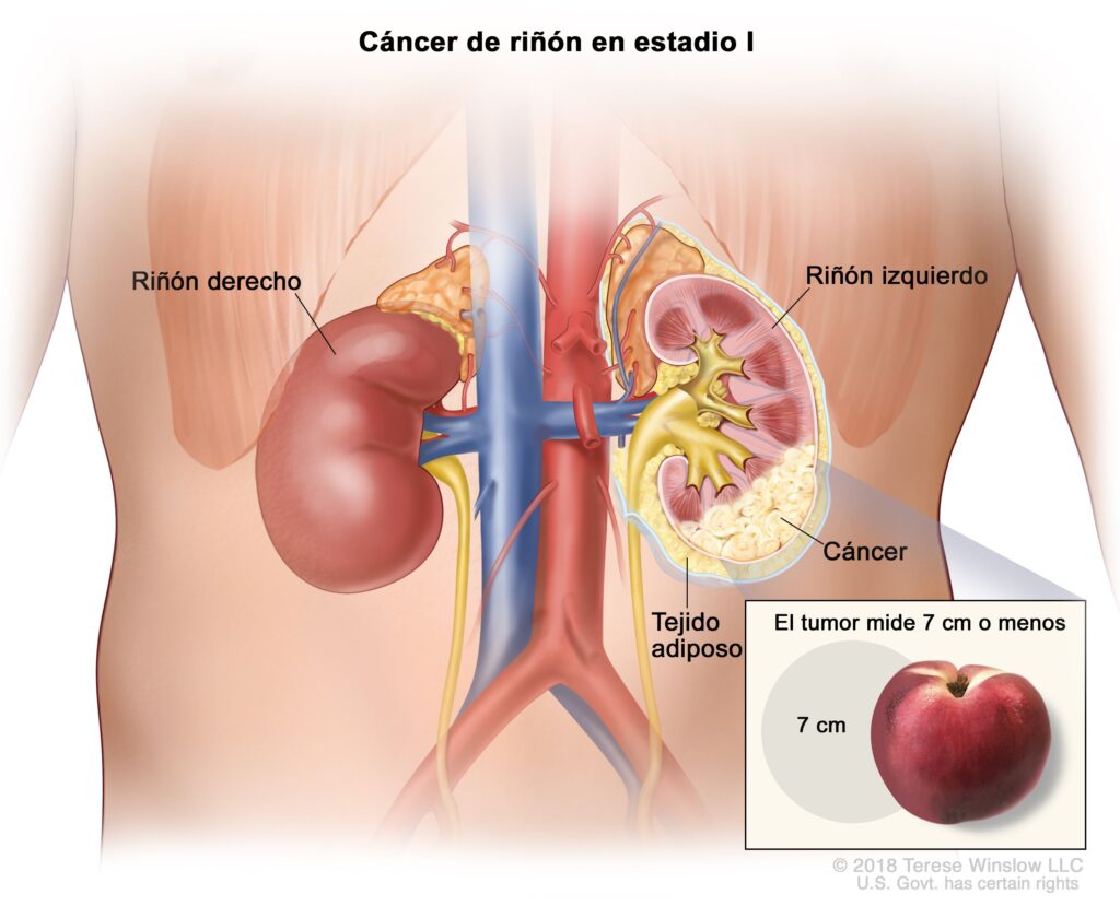 cancer de riñon